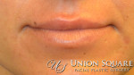 Lip Enhancement