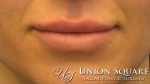 Lip Enhancement