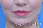 Lip Lift / Lip Augmentation