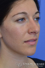 Rhinoplasty / Ethnic Rhinoplasty