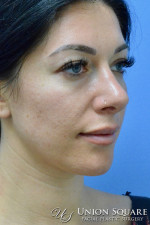 Rhinoplasty / Ethnic Rhinoplasty