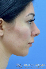 Rhinoplasty / Ethnic Rhinoplasty