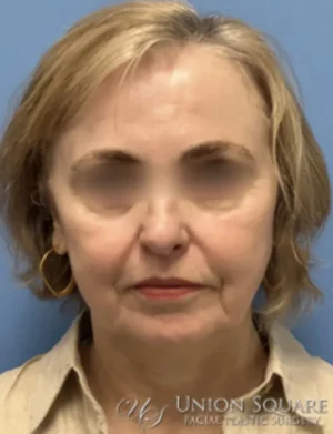 Lip Lift / Lip Augmentation