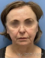 Lip Lift / Lip Augmentation