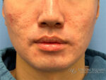 Buccal Fat Removal