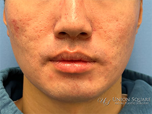 Buccal Fat Removal