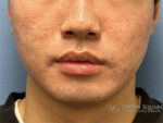 Buccal Fat Removal