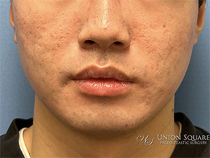 Buccal Fat Removal