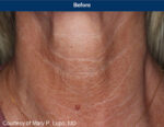 UltraClear Laser