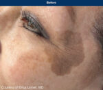 UltraClear Laser