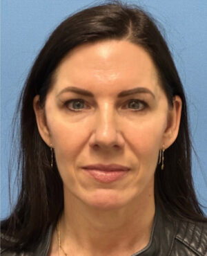 Liquid Facelift