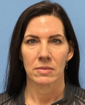 Liquid Facelift